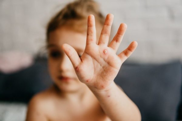 Hand, foot, and mouth disease: Know everything about it
