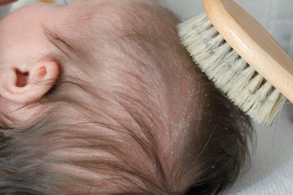 What Is Cradle Cap and What You Can Do About It