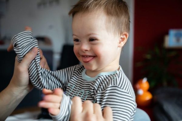 Down Syndrome: Causes And Physical Features