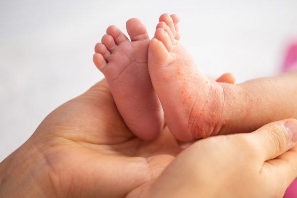 Heat Rash In Babies: What Is It And How To Treat It?