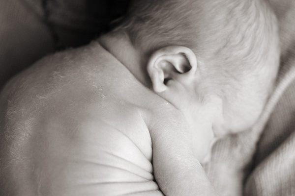 Is Lanugo Normal in Newborns?