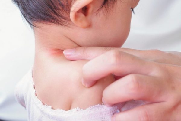 baby birthmarks
