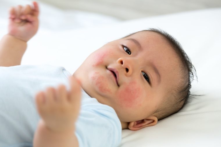 red spots on baby's face